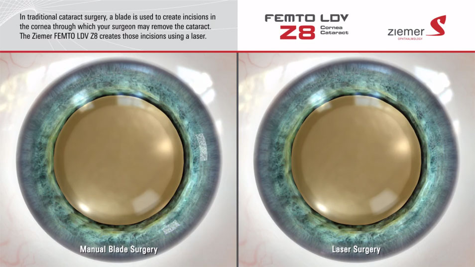 Laser-Assisted Cataract Surgery