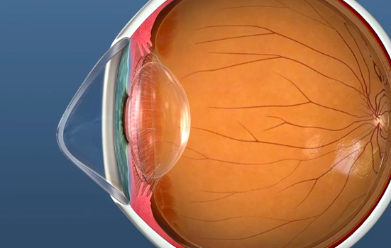 Keratoconus Treatment