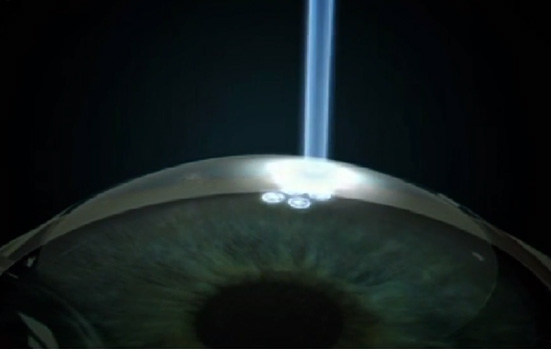 LASIK Surgery