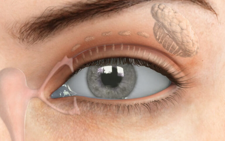 Dry Eye